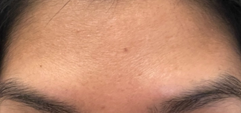 AFTER BOTOX