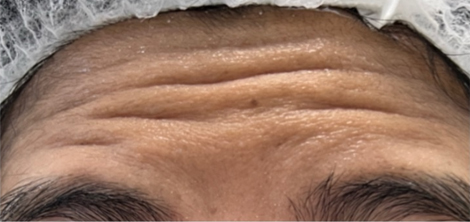 BEFORE BOTOX